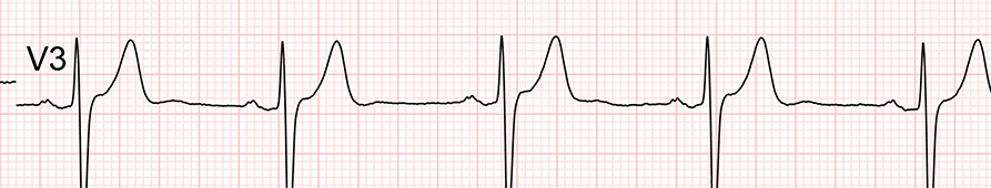 Reloj ECG: Guía Paso a Paso para ECG de 12 Derivaciones