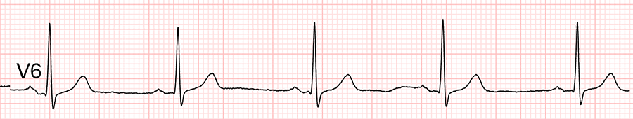 Reloj ECG: Guía Paso a Paso para ECG de 12 Derivaciones